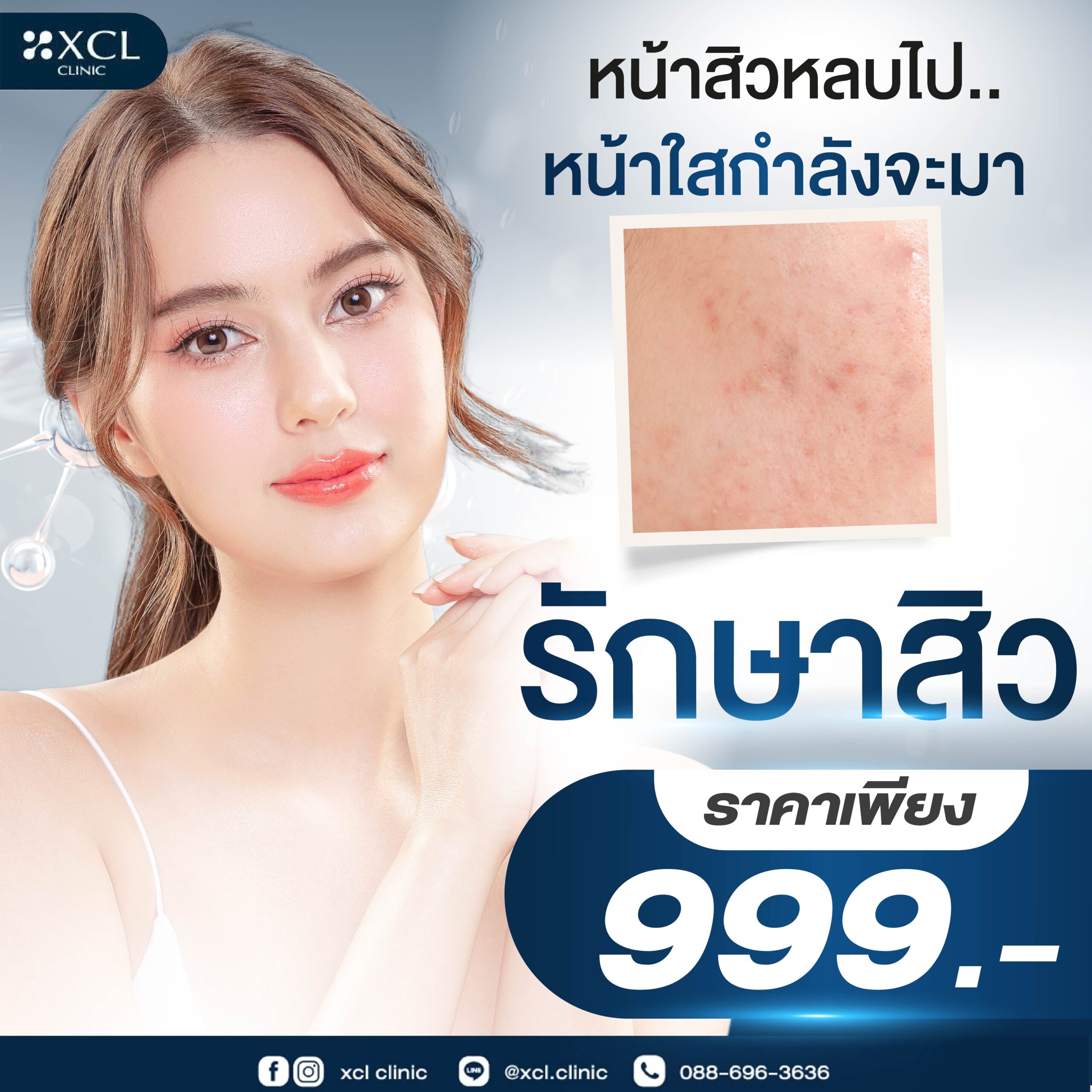 รักษาสิว