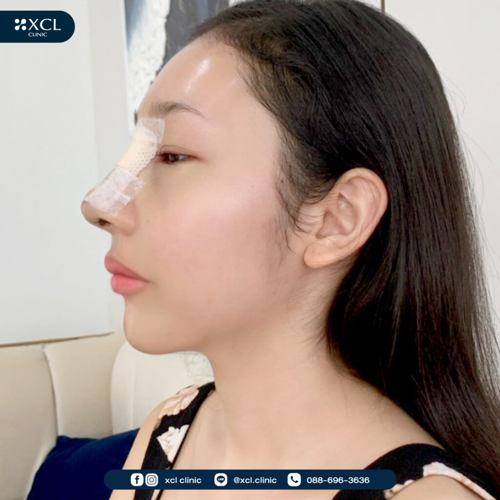 เสริมจมูก