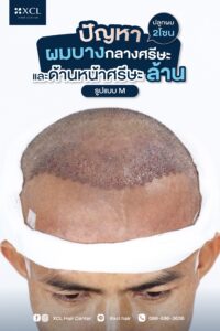 เคสปลูกผม2โซน