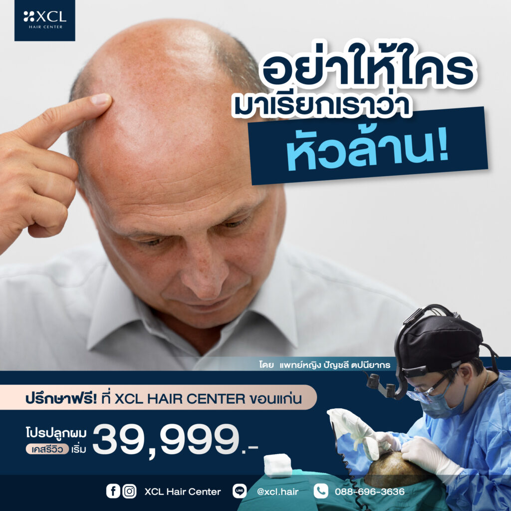 ปลูกผมหัวล้าน