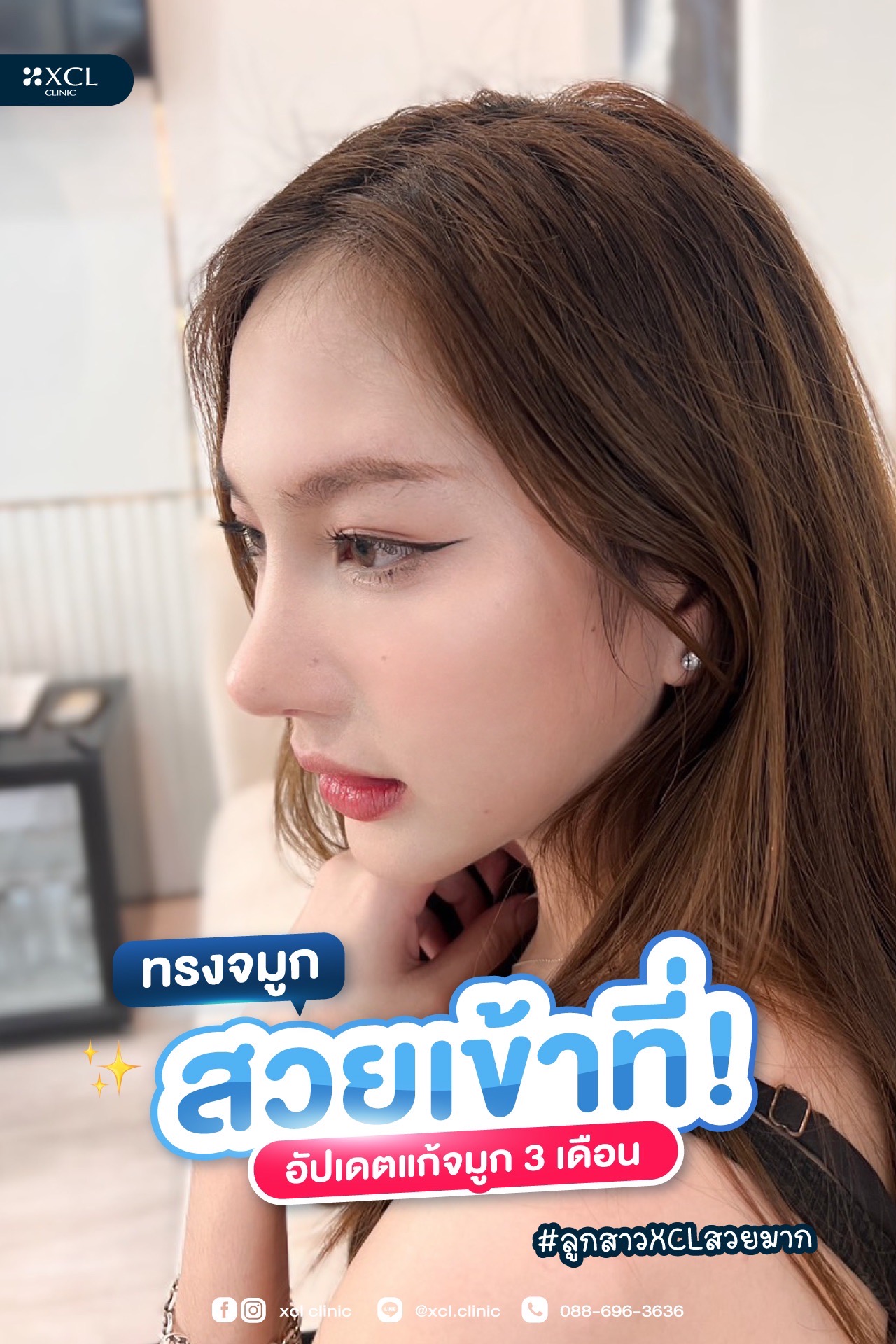 อัพเดทจมูก ลูกสาวXCL 3 เดือน